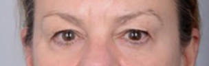 Before and After Eyelid Surgery in New York