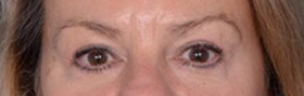 Before and After Blepharoplasty in Seattle