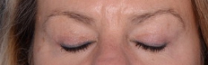 Before and After Blepharoplasty in NYC