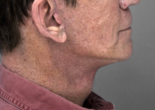 Before and After Neck lift in Manhattan