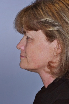 Comprehensive Facelift Before and After 01