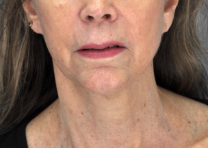 Before and After ultherapy in Seattle
