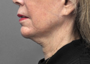 Before and After ultherapy in Seattle